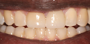 Smile Gallery - After