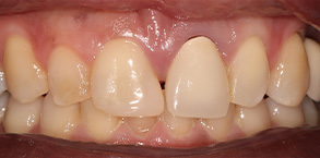 Smile Gallery - Before