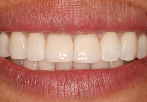 Smile Gallery - After