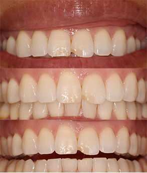 Smile Gallery - Before