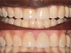 Smile Gallery - After